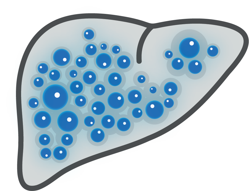 Cirrhosis of the Liver