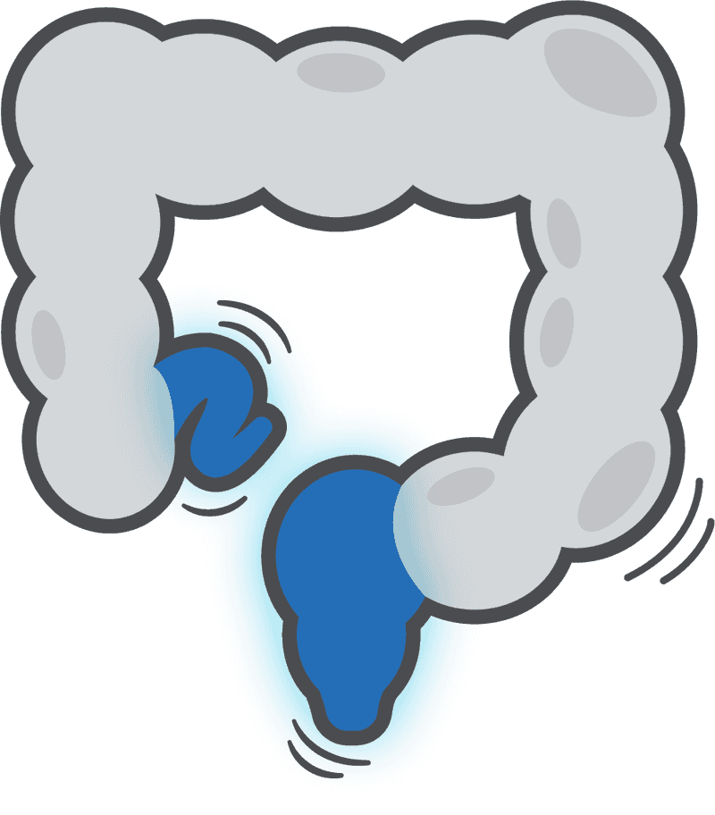 Crohn's Disease
