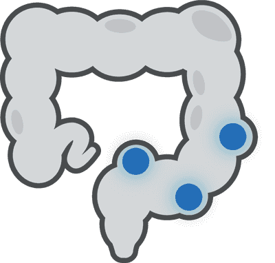 Diverticulitis