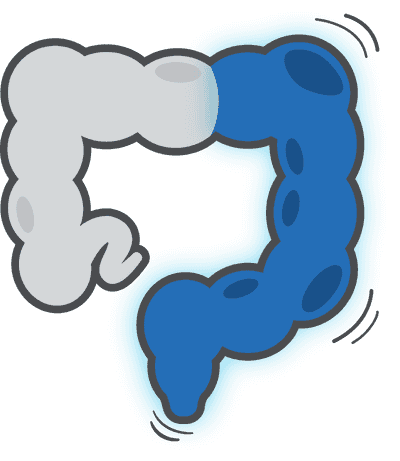 Colitis