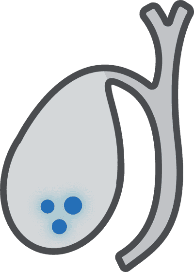 Gallstones