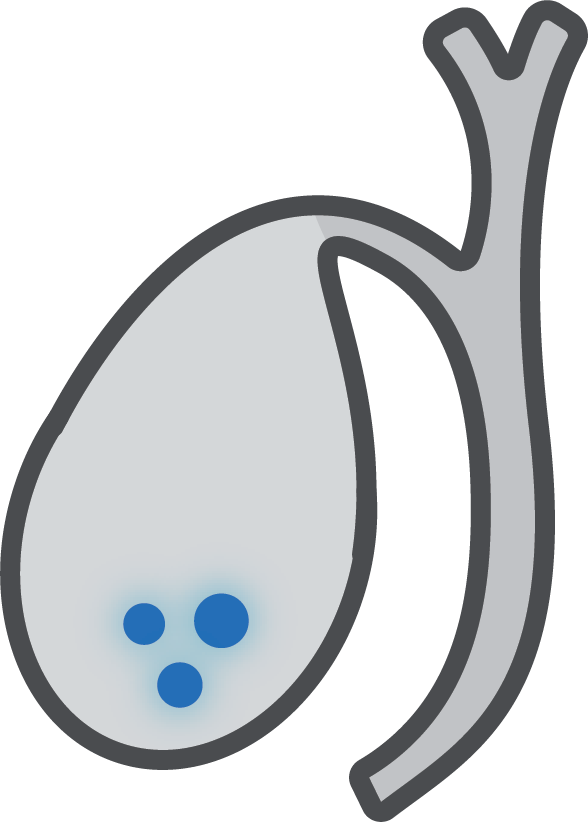 Gallstones
