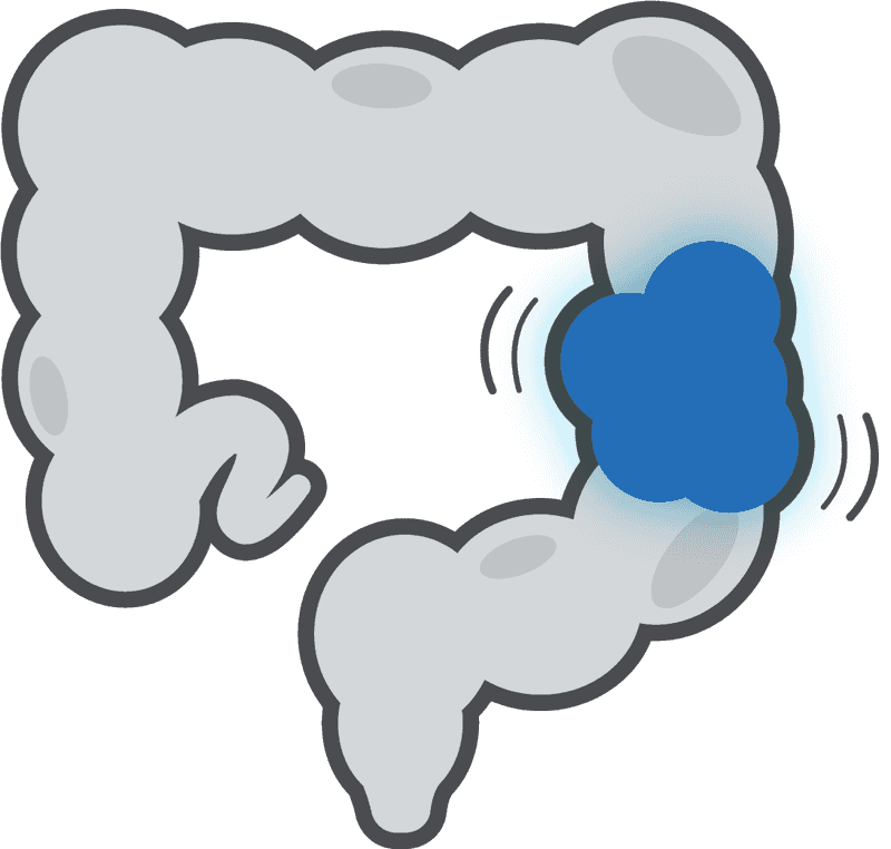 Colon Cancer