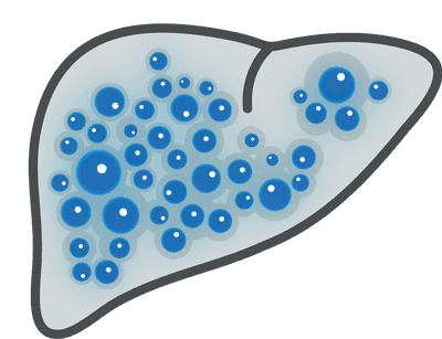 Cirrhosis of the Liver
